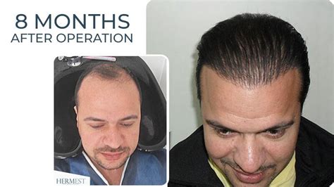 hermes haartransplantation|hermest haare erfahrungen.